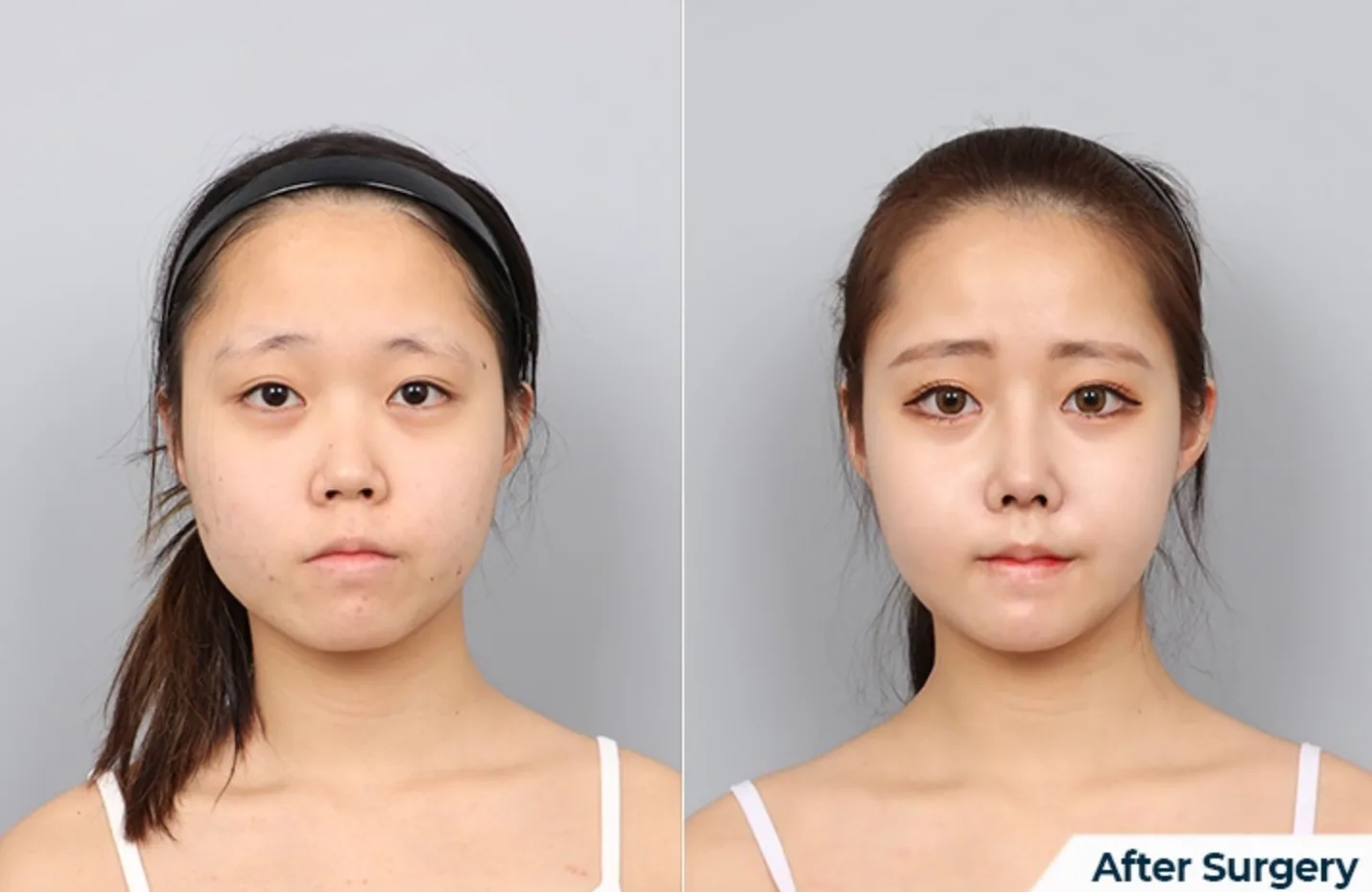 Facial Contouring + Rhinoplasty + Paranasal Augmentation + Non-incisional Double Eyelid