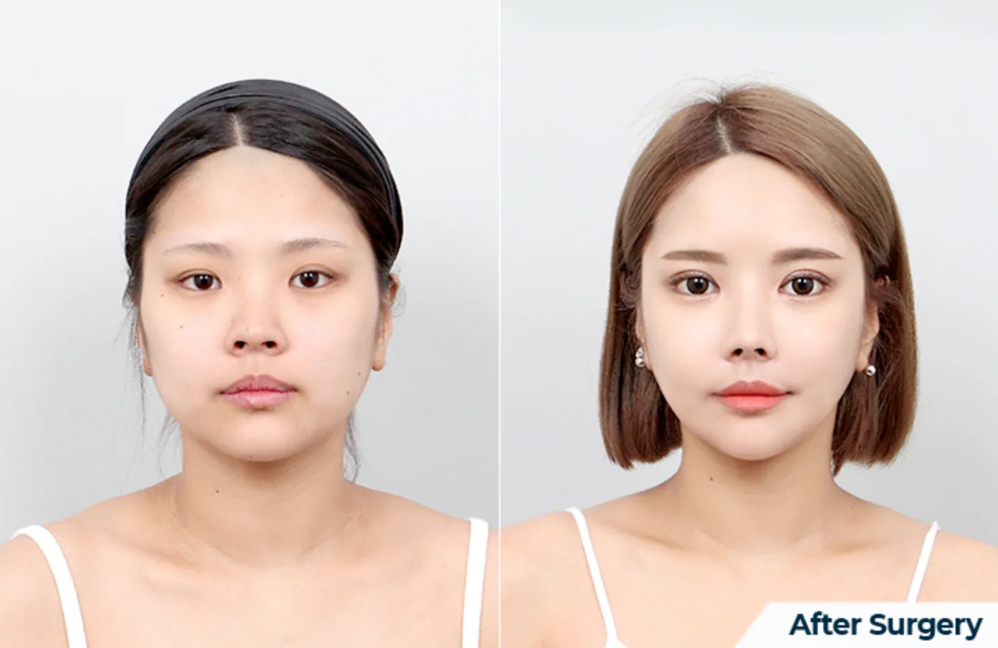 Shaping Facial Contouring + Jaw Reduction + Turning Zygoma Reduction