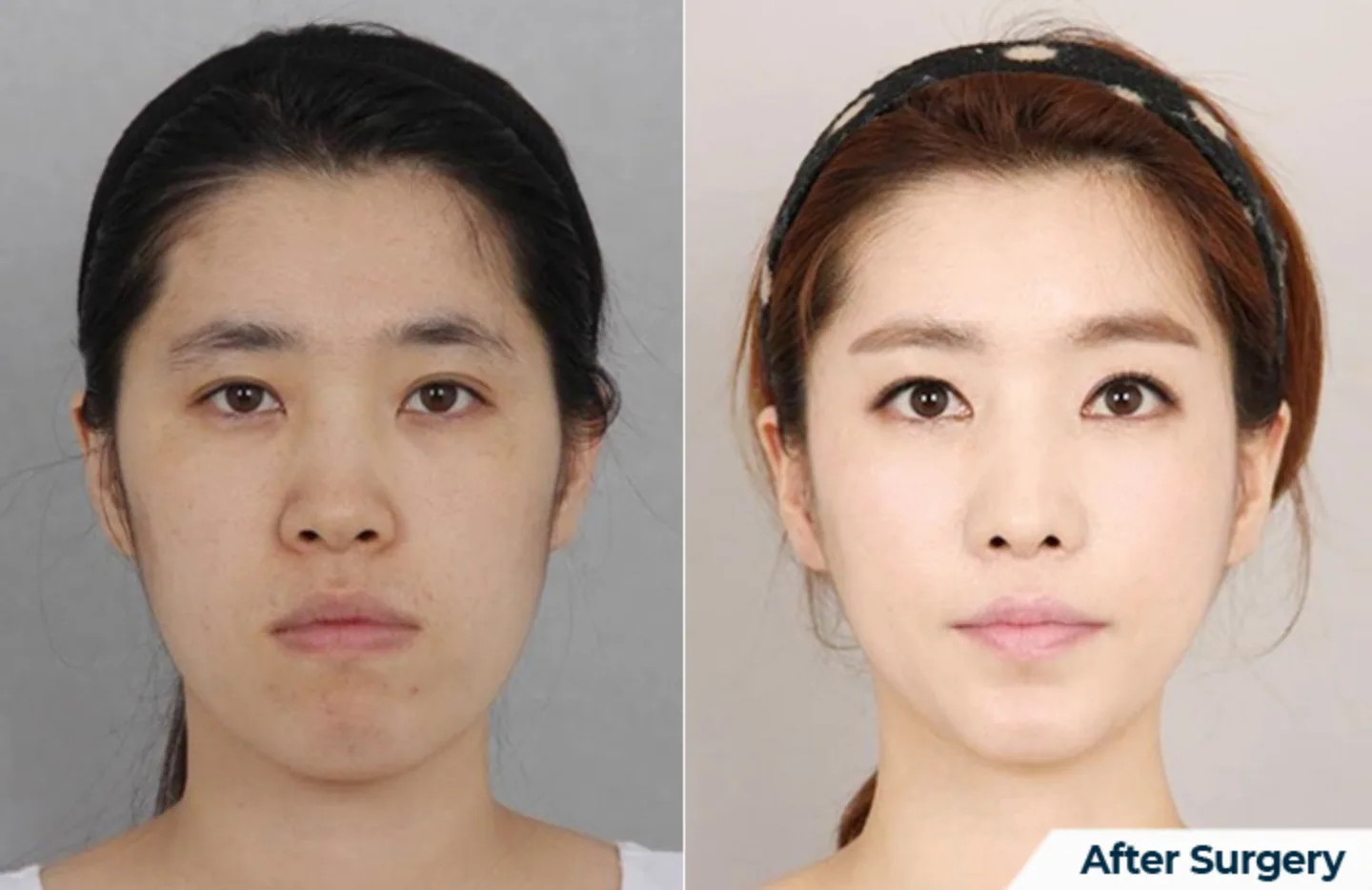 Two Jaw Surgery