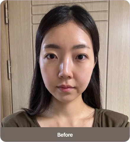 Before and after 2030-lifting