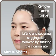 AFTER · 10 MONTHS classic facelift