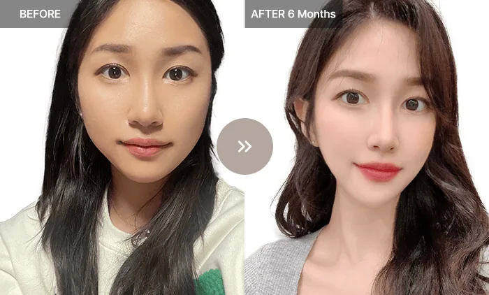 Before and after thread-lifting