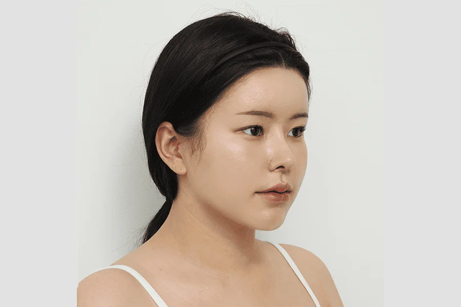 face-liposuction after