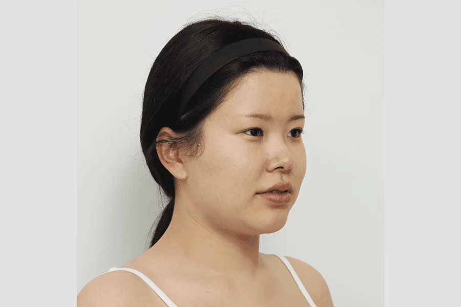face-liposuction before
