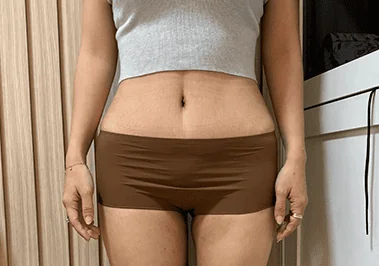 liposuction-area after