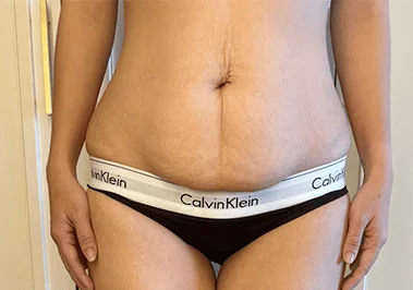 liposuction-area before