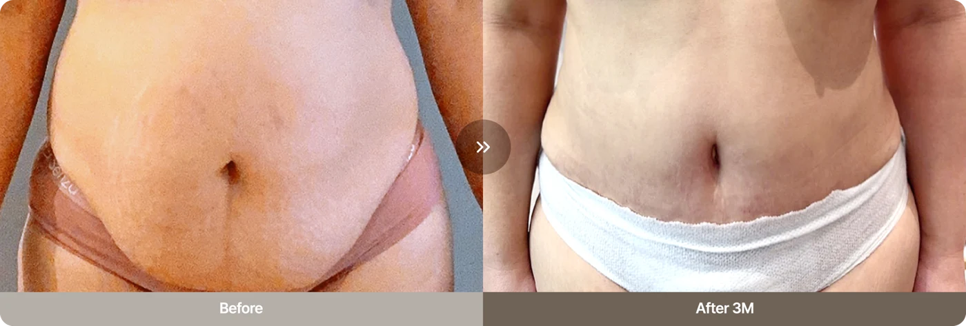Before and after Tummy Tuck: area perut