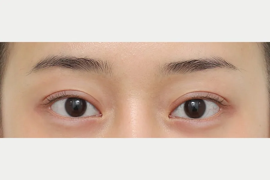 Double eyelid case 1 — after