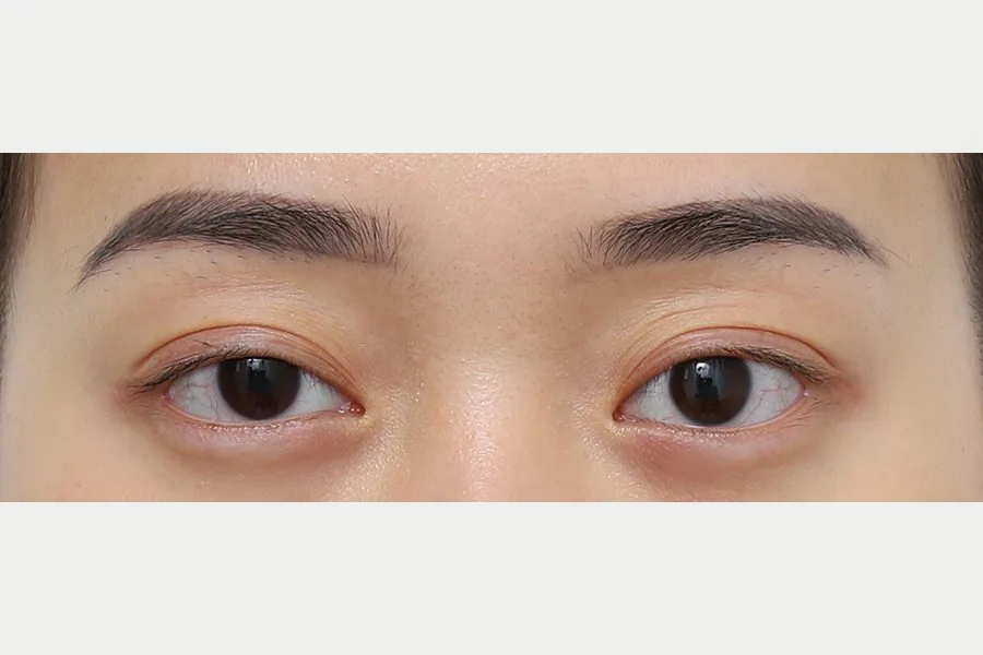 Double eyelid case 1 — before