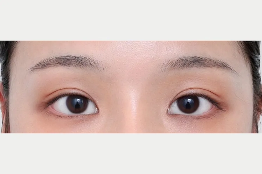 Double eyelid case 2 — after