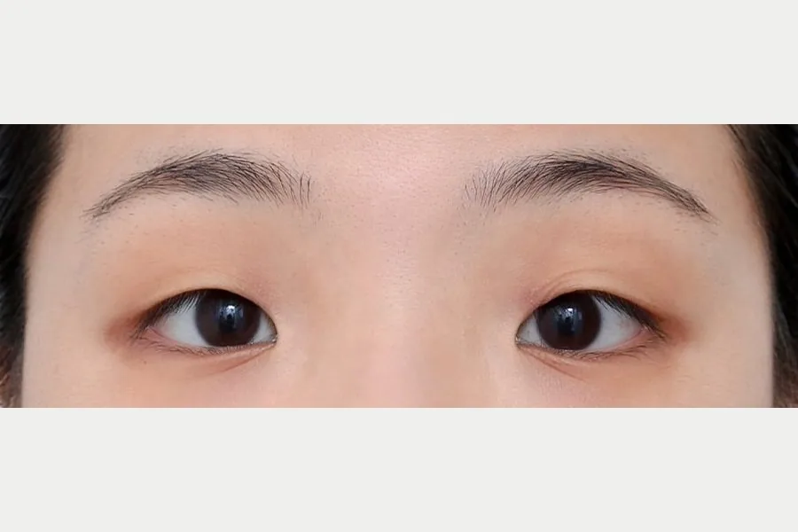Double eyelid case 2 — before