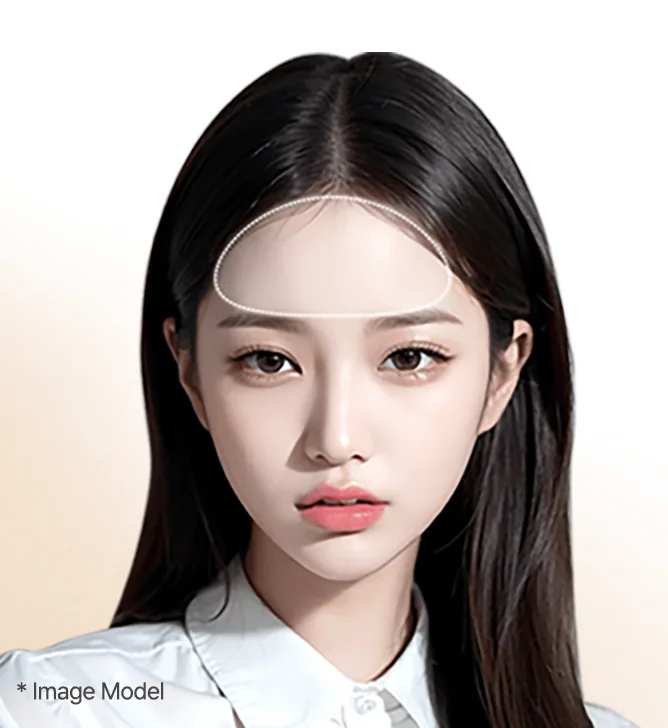 Forehead implants