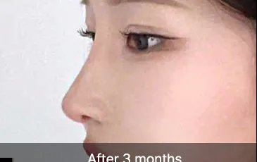 Model 3 weeks after rhinoplasty
