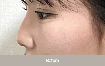 Actual model before functional nose surgery