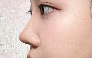 Actual model 2 months after implant-free nose tip surgery
