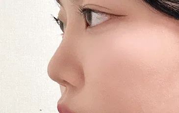Actual model before non-implant nose tip surgery