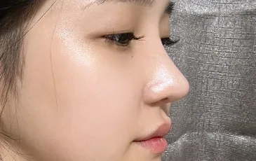 Actual model 2 months after rhinoplasty revision surgery