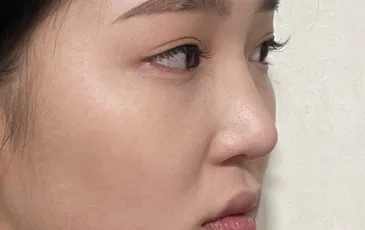 Actual model before rhinoplasty revision surgery