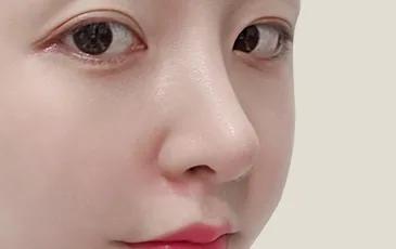 Actual models 9 months after rhinoplasty by type