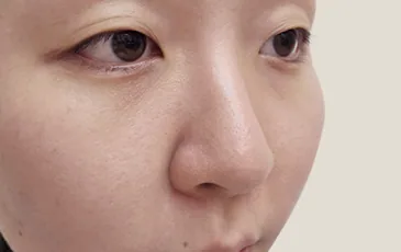 Patient before rhinoplasty surgery