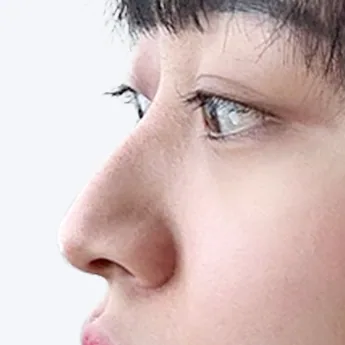 Nose type 3 before