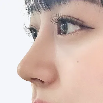 Nose type 3 after