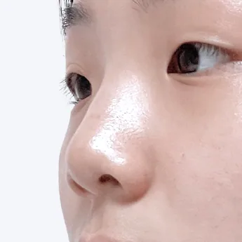 Nose type 4 before