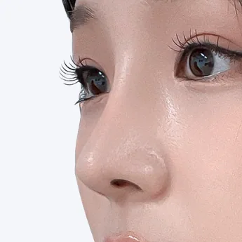 Nose type 4 after