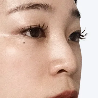 Nose type 5 before