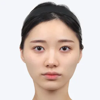Nose type 6 before