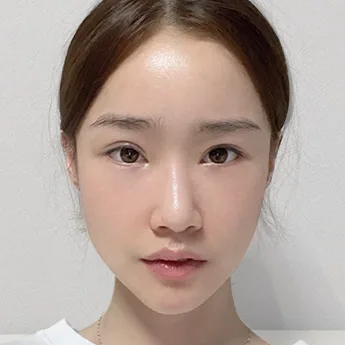 Nose type 1 before