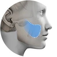 Buccal fat removal