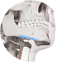 Masseter reduction