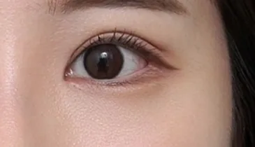 after canthoplasty