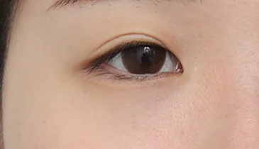 before canthoplasty