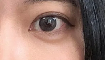 after double-eyelid-revision