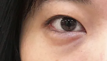 before double-eyelid-revision