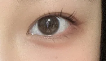 after ptosis-correction