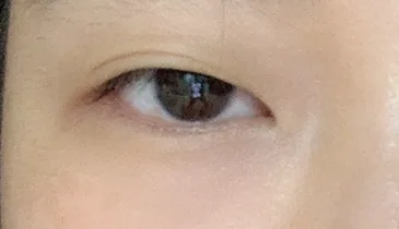 before ptosis-correction