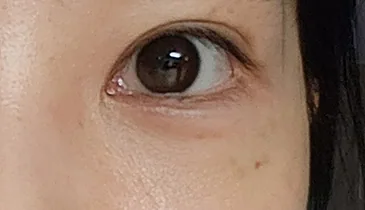 after under-eye-fat-reposition