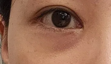before under-eye-fat-reposition