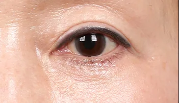 after upper-lower-blepharoplasty