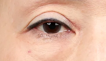 before upper-lower-blepharoplasty