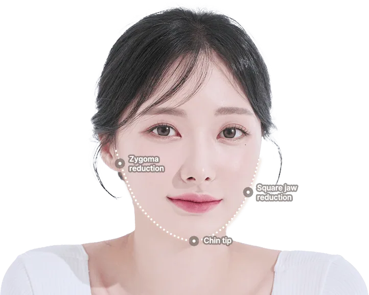 Model illustrating zygoma, square jaw, and chin tip contouring