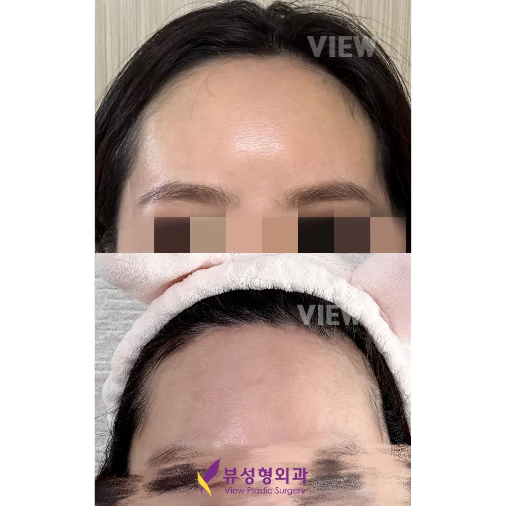 VIEW Plastic Surgery — Pengangkatan dahi (pengangkatan implan), pengecilan dahi
